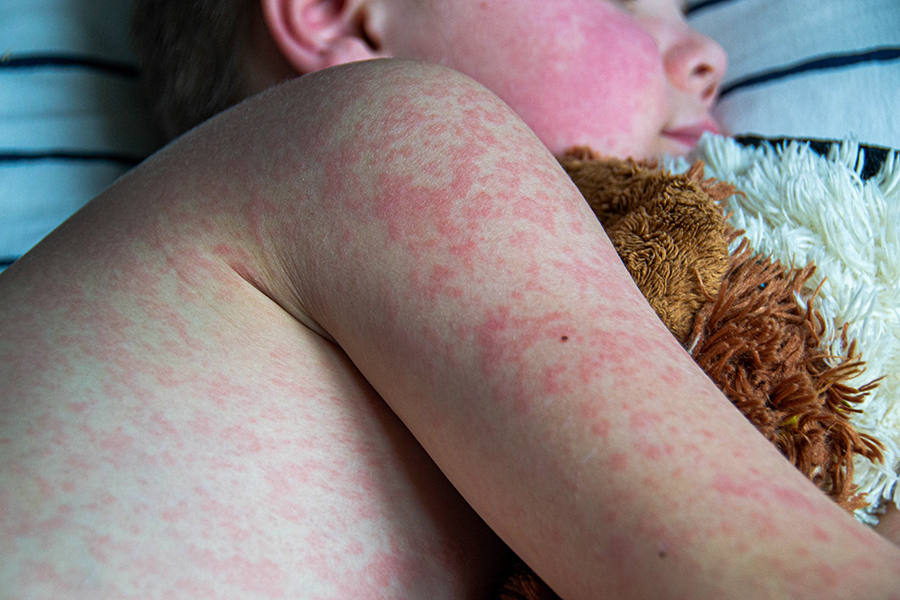 Viral disease. Measles rash on the body of the child. Allergy. A handsome boy with measles is sleeping in bed with his soft toy High quality photo